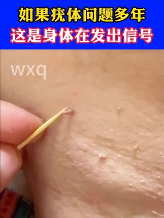 脖子上、腋下长了小肉条,别去揪,这是丝状疣,小心会传染! #hpv 脖子上、腋下长了小肉条,别去揪,这是丝状疣,小心会传染!#脖子上的小肉粒 #丝状疣 #丝状疣祛除 #疣
