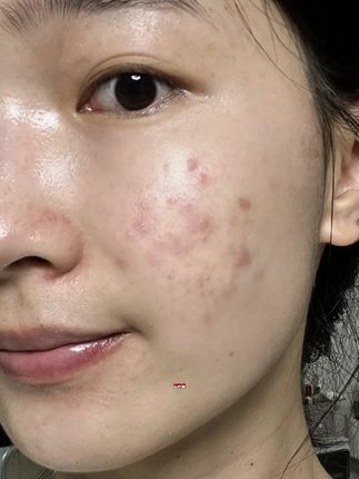 姿珂莱小黄瓶祛痘精华乳改善痘印痘坑痘疤疏通毛孔减少黑头粉刺