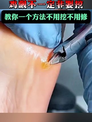 鸡眼越挖越多,不如来试试它,#鸡眼 连根拔起简单又方便#鸡眼跖疣 #老茧怎么去除 #老茧 #老茧怎么去除