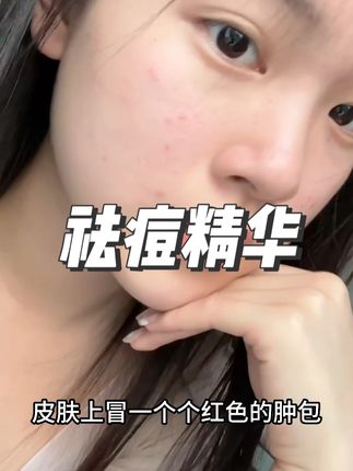 八年战“痘”人,我不允许有人在祛痘这条路上走弯路! #祛痘精华 #祛痘 #护肤 #去痘印 #修护精华