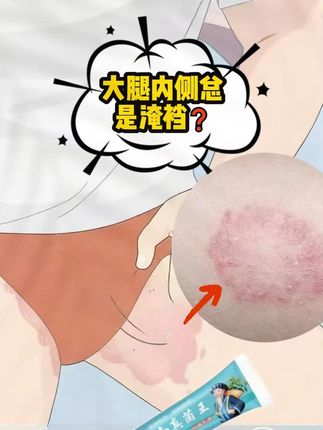 大腿内侧夹缝处潮湿异味外用软膏 爸爸优秀孩子一定优秀,孩子80%的缺点都来源于爸爸 #父母课堂 #亲子关系 #好爸爸 #张予曦毕雯珺真拍了红裙抱 #显瘦穿搭