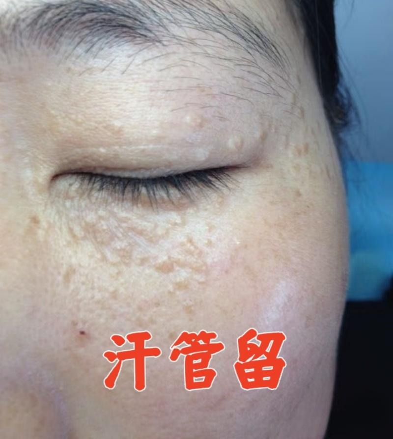 【香港研发】眼部眼霜 眼部小粒粒 颗粒