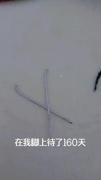 克氏针在我脚上,#克氏针,#骨折。