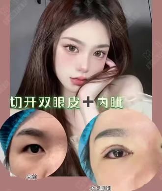 双眼皮做了。眼睛漂亮了。形状比之前好看了。