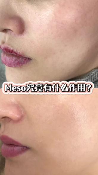 【操作Meso的作用究竟是什么?】
应该就像是“浇水”和“施肥”吧!