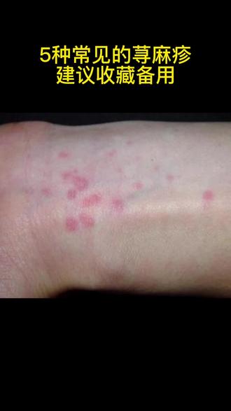 生活中5种常见的荨麻疹,你遇到过吗? #荨麻疹 #长治第二人民医院 #医学科普