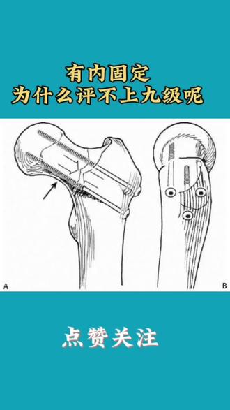 有内固定为什么评不上九级呢?今天我来告诉你#上热门 #工伤鉴定 #工伤认定 #工伤 #工伤赔偿 #法律咨询 #抖来普法2022 #今日热门🔥 @DOU+小助手 @DOU+上热门 @创作灵感小助手