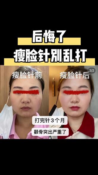 很多小伙伴只是盲目跟风不了解自己的情况适不适合打都不知道,打针之后颧骨更突出了,所以千万不要盲目选择@抖音小助手 #我要上热门#瘦脸#面部护理