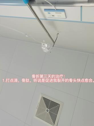 骨折第三天的治疗:第一次针灸,那痛感还能接受。