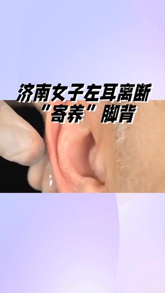 济南女子左耳离断“寄养”脚背
