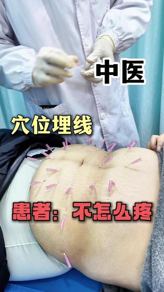中医穴位埋线 瘦肚子 #瘦肚子 #减肥 #埋线减肥 #郭广宇预约
