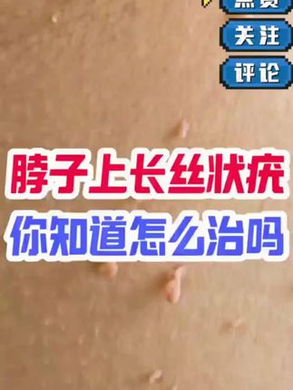 脖子上长丝状疣小肉粒怎么办,一招帮您解决。北京同仁堂去疣凝胶,每天抹抹轻松脱落#涨知识 #强烈推荐 #丝状疣 #扁平疣#去疣