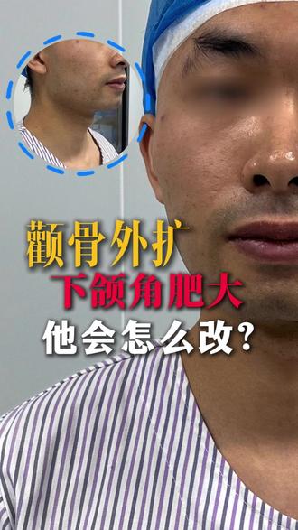 小哥颧弓外扩、下颌角肥大,看看怎么改! #磨骨三件套 #下颌角 #颧骨内推 #下颌角磨骨 #杜本军
