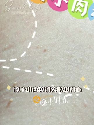 #小肉粒怎么处理 #小肉粒涂抹液 #脖子小肉粒 #去脖子上的小肉粒