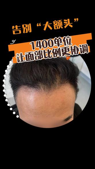 大额头植发1400单位让面部比例更协调 #发际线 #脱发 #植发 #防脱生发