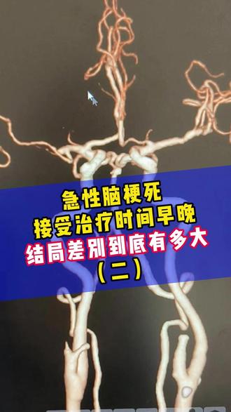 脑梗塞 急性脑梗死接受治疗时间早晚,结局差别到底有多大?#脑梗塞 #医学科普