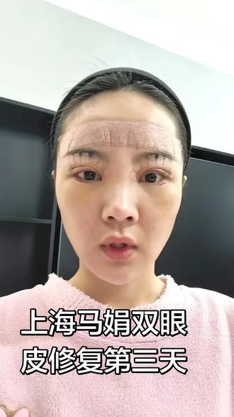 马娟双眼皮修复第三天#马娟双眼皮 #马娟