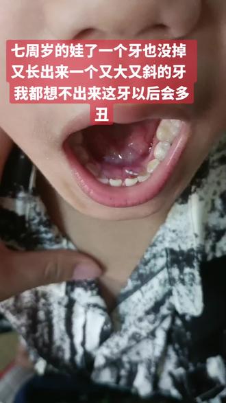 #换牙啦 要不要拔掉一个啊 拔新的拔老的 两个都挺牢固的 😂