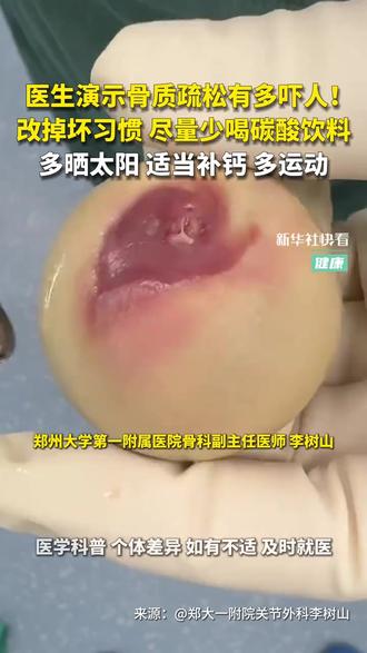 医生演示骨质疏松有多吓人!改掉坏习惯,尽量少喝碳酸饮料,多晒太阳、适当补钙、多运动(来源:新华社快看)