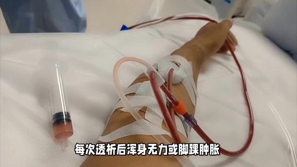 告别猜测:科学4步找到你的理想干体重 #干体重 #透析 #肾友 #控水