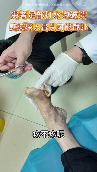 糖尿病患者足部有水泡需要特别注意 #糖尿病 #糖尿病足 #武汉梨园医院糖尿病足 #抖出健康知识宝藏