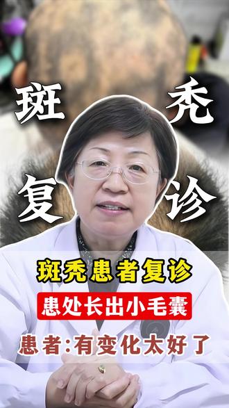 斑秃患者复诊,患处长出小毛囊,患者:有变化太好了 #宋佩华#中医#养发#脱发#斑秃