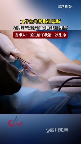 女子左耳被撕扯离断,在脚背"寄养"5个月后移回头部,当事人:医生给了我第二次生命#福在福山 #脚背寄样耳朵 #手术