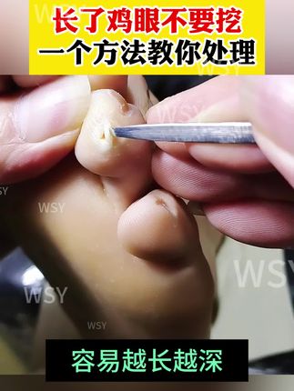 长了鸡眼不要乱挖,试试我这个方法,在家就能做#鸡眼 #鸡眼去除小妙招 #鸡眼怎么办 #鸡眼怎么去除 #鸡眼怎么造成的