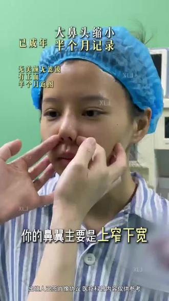 大鼻头女孩半个月直接逆袭顶美少女 #大鼻头 #鼻整形案例 #肋骨鼻综合 #立体鼻子 #好看的鼻子可以拯救一张脸