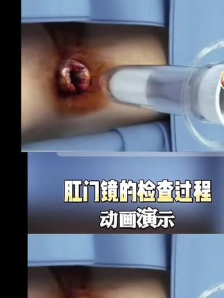痔疮术后,凝胶养护