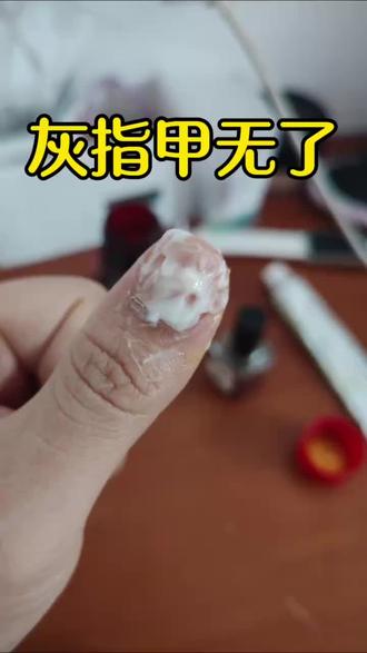 #灰指甲 #灰指甲用药推荐 #灰指甲怎么办 #灰指甲怎么治疗