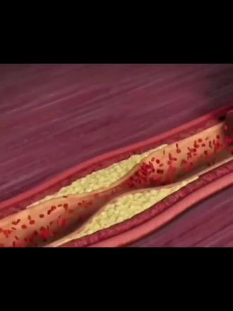 改善血液循环,美国进口阿替普酶胶囊轻松守护健康! 阿替普酶口服生物支架