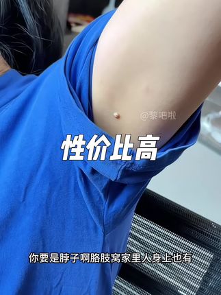 脖子身上有长这个的可注意的 #疣 #超便宜超划算