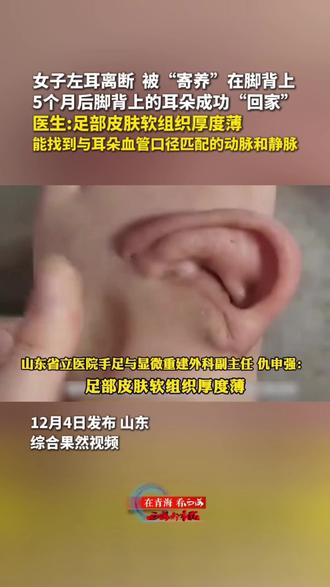 女子左耳离断,被“寄养”在脚背上,5个月后脚背上的耳朵成功“回家”。医生:足部皮肤软组织厚度薄,能找到与耳朵血管口径匹配的动脉和静脉。