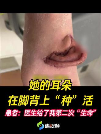 脚背上“长”耳朵?世界罕见的“异位寄养”手术在山东济南成功实施!#异位寄养 #耳朵 #惊呆了 #热门 #真实事件