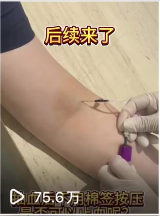 无论是按压穿刺部位,还是旁边位置,只要拔针后按压了都会止血! #扎针的过程 #扎针 #护士懂护士 #放射科护士 #全景医学