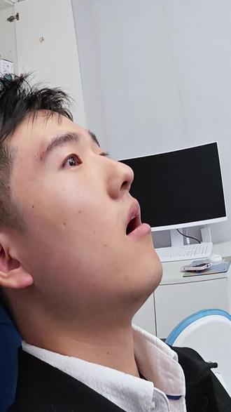 【沉浸式do鼻+眉弓+颞区】不敢相信这是我!帅麻了 #男生变帅 #男生变帅成本有多低 #注射鼻子 #上海注射医生黄晔文 #上海微调