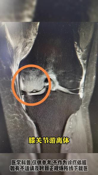 #膝关节游离体 主要是通过以下几种方式产生的。
首先是剥脱性骨软骨炎,由于外伤或其他不明原因,关节软骨和软骨下骨出现缺血性坏死,之后剥脱形成游离体。比如青少年在运动过程中膝关节受伤后可能引发这种情况。
其次是滑膜骨软骨瘤病。滑膜细胞化生为软骨体,这些软骨体或者脱落,或者通过蒂与滑膜相连,脱落后就成为游离体在关节腔内活动。
再者,关节面骨折后,碎骨块没有被吸收或者复位,留在关节腔内形成游离体。就像老年人因摔倒等意外导致膝关节骨折,若处理不当就会出现这种情况。
另外,#半月板撕裂 后,碎片也可能脱落进入关节腔,成为游离体,通常在剧烈运动或长期磨损后易出现。#膝关节炎 #医学影像 #硬核健康科普行动