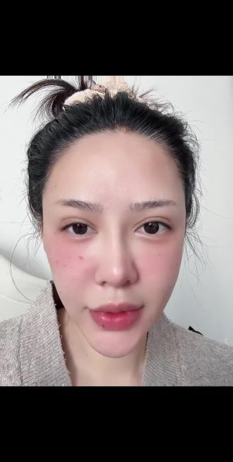 #原相机怼脸live 给各位有biu水光习惯的姊妹们安利一下 我在实践中得到的一些感受哈 本人biu💉水光的材料都比较k衰的 浓度较高 习惯手打 姊妹们习惯不同 根据自己的喜好选择哈 #随意拍今日装嫩篇章