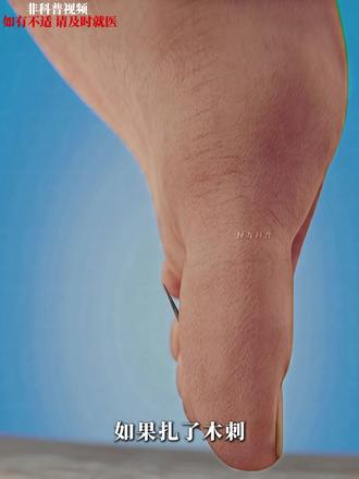 拔刺的时候可以试试这个方法啦 #抖进科学 #科普 #科普一下