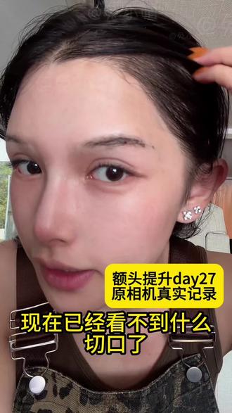 额头提升马上满一个月了,已经无所畏惧素颜出门了#额头提升 #眉压眼 #原相机记录 #上海李晓霞 #变美