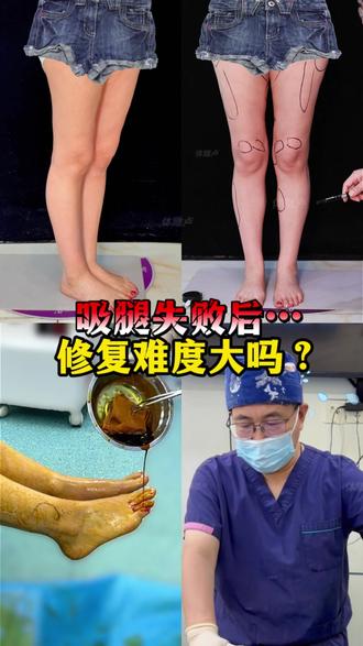 吸腿失败后,还能直腿术修复吗? #直腿术 #腿不直 #凹凸不平修复
