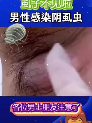 苗先锋云南本草药业百部酊喷雾剂男女阴用成人祛除虱子虱卵虱立净一扫光正品#长虱子怎么消除 #消除虱子卵的小妙招 #身上长虱子怎么消除 #草本植物 #百部酊喷剂语音转文字