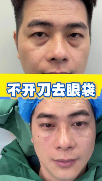不开刀去眼袋 #去眼袋 #不开刀去眼袋
