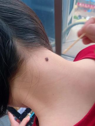 #经验分享 #精致女人必备 #脖子上的小肉粒