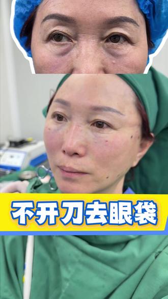不开刀去眼袋 #去眼袋 #不开刀去眼袋
