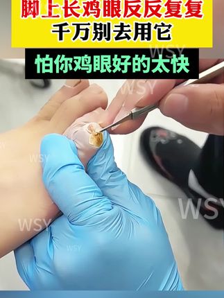 脚上鸡眼反反复复,一个方法连根带走#鸡眼 #鸡眼去除小妙招 #鸡眼怎么去除 #鸡眼怎么造成的 #鸡眼去除小妙招