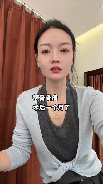 额骨骨瘤,术后一个月了,现在恢复的很满意。