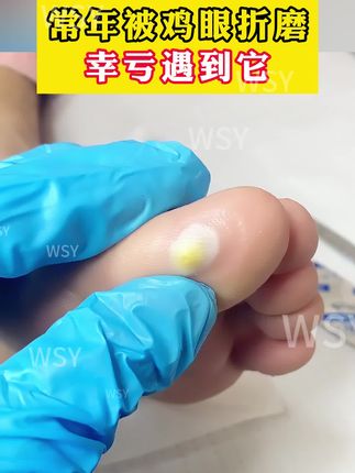 脚上长鸡眼,幸亏有了它#鸡眼去除小妙招 #鸡眼 #鸡眼怎么办 #鸡眼怎么能彻底根治 #鸡眼怎么去除