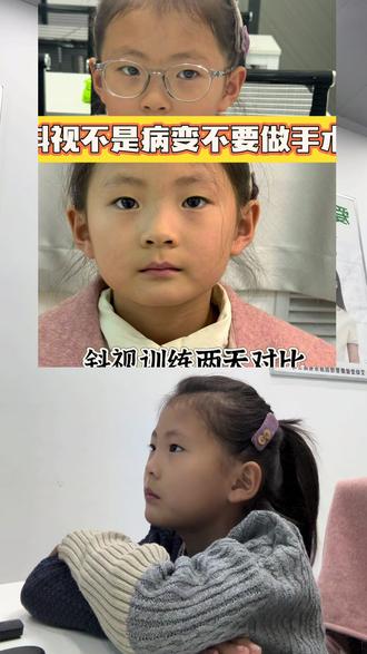 6岁半一年级杨逸可小朋友真实反馈✨
训练前:一只眼200多度、一只300多度,近视+散光还有斜视,摘镜看不清黑板
坚持物理训练三周👉
不再有斜视的感觉,能清晰看清黑板!
每天用完视力保,都说眼睛暖暖的、热热的,摘掉后看东西更亮了~
孩子不会说谎,肉眼看得见👶
近视不可怕,可怕的是放任不管
假性近视黄金期一定要抓住
别等拖成高度近视才后悔
眼镜不是万能的,科学防控+坚持训练,才是给孩子最好的护眼方式💪